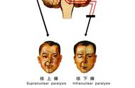 面瘫的基本诊断治疗