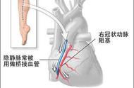 心外科主任提醒：心脏搭桥手术出院后，伤口保护有6点