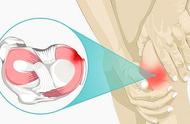 走路膝盖疼，屈膝髌骨上方鼓个包，像个“鸡蛋”，这是啥情况？