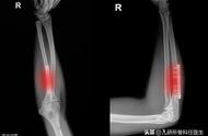 真相｜骨折术后内固定到底啥时候取？网上众说纷纭我该相信谁