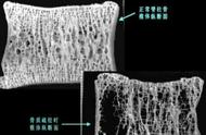 如何预防和治疗骨质疏松症