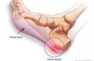 识别&诊治「 足底筋膜炎」，简单三步走