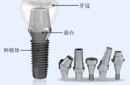 种植牙的制作材料介绍 当心种植牙术后“工作”