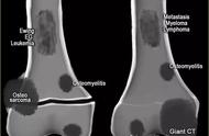 9种边界不清的溶骨性肿瘤和肿瘤样病变