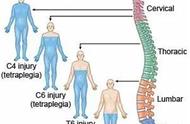 多了解一二，避免掉入脊髓损伤深坑