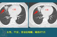 有1种肺癌早期误诊率接近50%，女性更多见