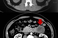 巨大肿瘤竟在身体里玩起“漂移”！10个月里移动了10厘米