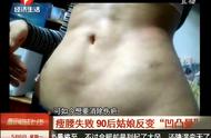 抽脂瘦腰失败，90后姑娘反变“凹凸曼”：疤痕看着就像蜈蚣一样