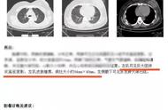 身体发现肿块她选择用按摩消除，结果一年后崩溃了……