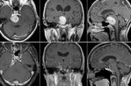 位置复杂的枕骨大孔脑膜瘤，复发几率到底有多大？