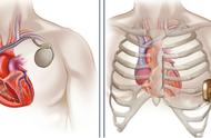 心脏“保护器”可以不“入心”袖珍起搏器只有2克重