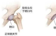 换人工关节，我差点逃出手术室