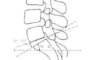 骶椎腰化/腰椎骶化、腰椎滑脱、腰肌劳损，简单易懂图解