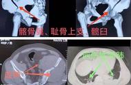 丨传承·创新丨——多学科协作奏响凶险骨折患者生命乐章