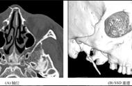鼻骨骨折 | 如何诊疗你掌握了吗？