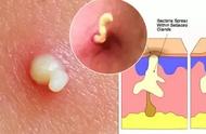 清滋颜：粉刺鼓包疼痛难受挤不住来怎么办？这里有高效处理方法