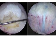 打球摔倒肩袖撕裂 关节镜下微创修复